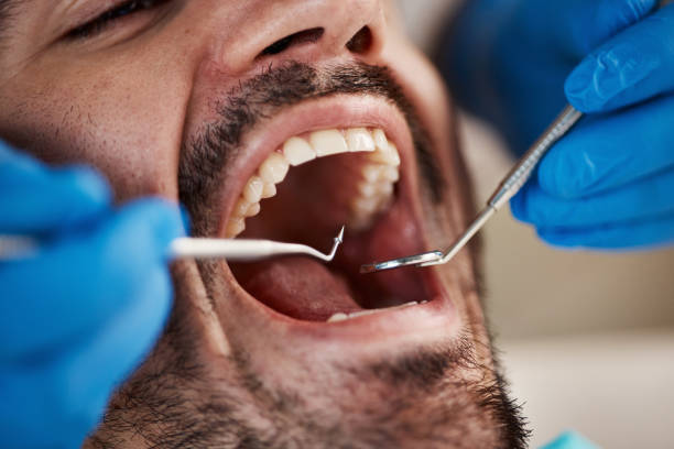 Full Mouth Reconstruction in Canterwood, WA
